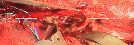 Surgical field after resection